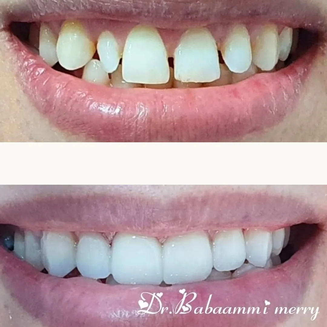 Before and after: top, spaced and uneven front teeth; bottom, the same teeth after treatment, even.