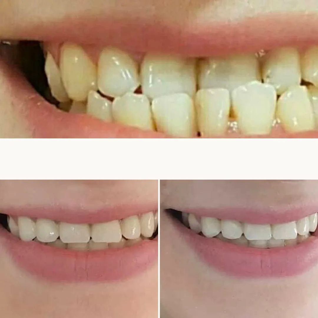 Avant et après : en haut, dents chevauchées et mal alignées ; en bas, deux vues du sourire après traitement, dents alignées.